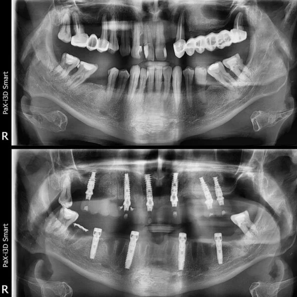 Proteza fixa pe implanturi - All on 4 / All on 6