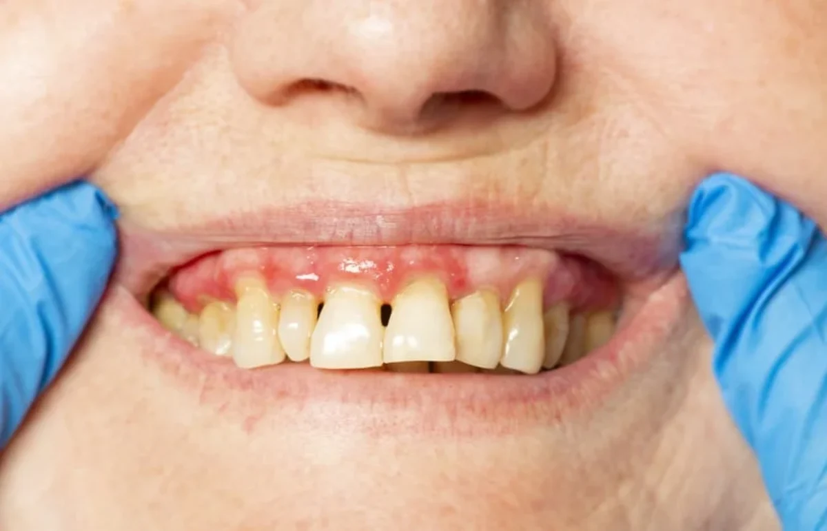 PARODONTOZA – ProDent Dr. Gruia