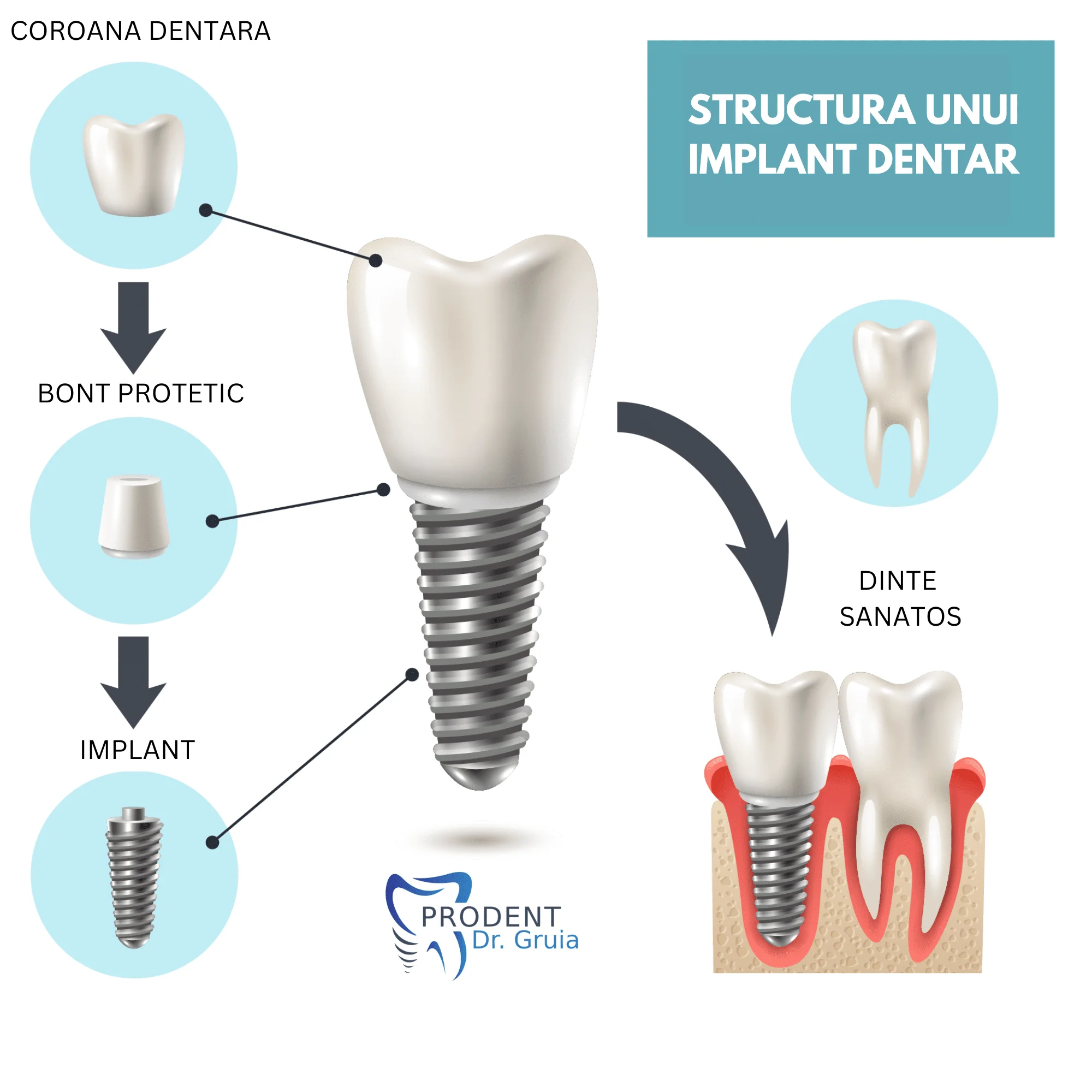 Implant dentar