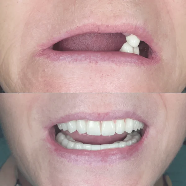 Proteza fixa pe implanturi - All on 4 / All on 6