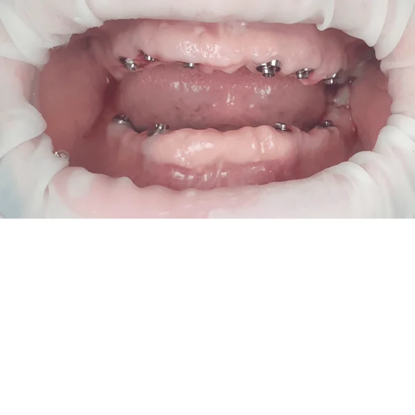 Proteza fixa pe implanturi - All on 4 / All on 6