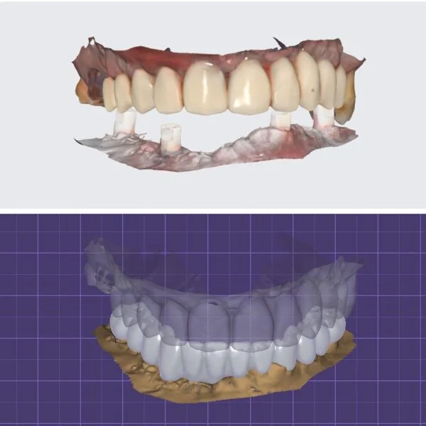 Proteza fixa pe implanturi - All on 4 / All on 6