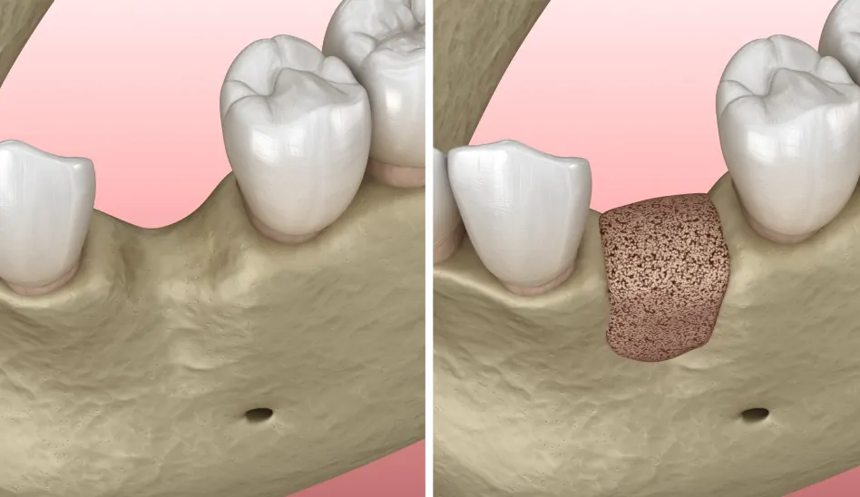 Adiție de os pentru implantul dentar