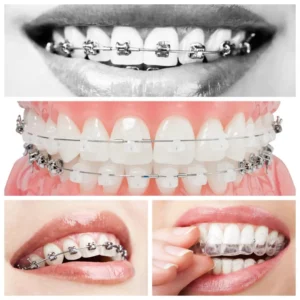 Aparate dentare fixe