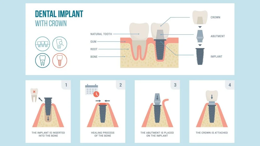 Implant dentar