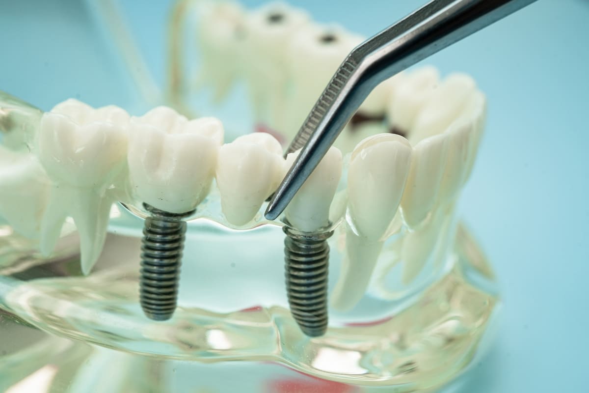 implant dentar premium pe mulaj digital