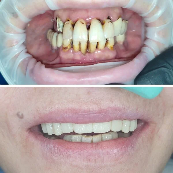 Proteza fixa pe implanturi - All on 4 / All on 6