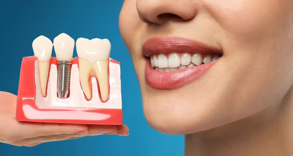 implant dentar pentru protetica dentara