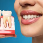 implant dentar pentru protetica dentara