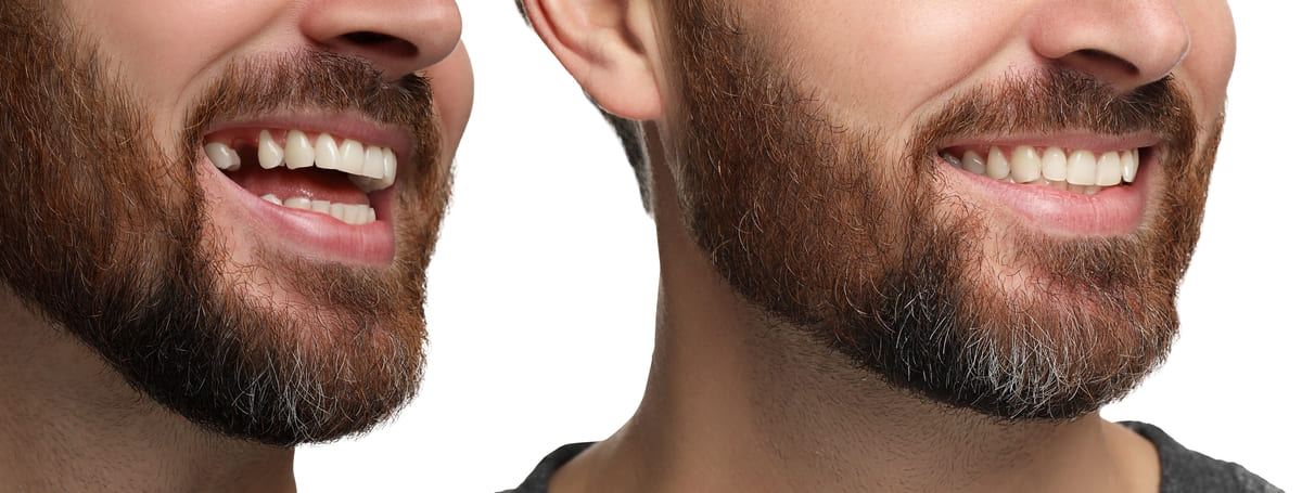 inainte si dupa implant dentar
