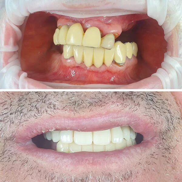 Proteza fixa pe implanturi - All on 4 / All on 6