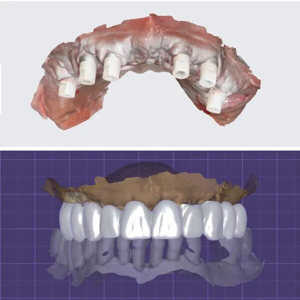 Proteza fixa pe implanturi - All on 4 / All on 6