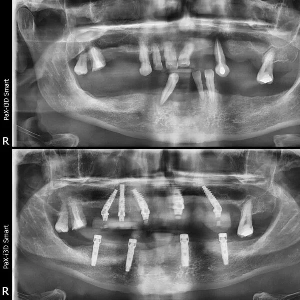 Proteza fixa pe implanturi - All on 4 / All on 6