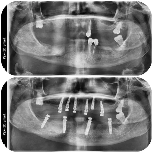 Proteza fixa pe implanturi - All on 4 / All on 6