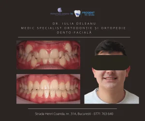 caz ortodontie Corecție dantură - Prodent Dr Gruia