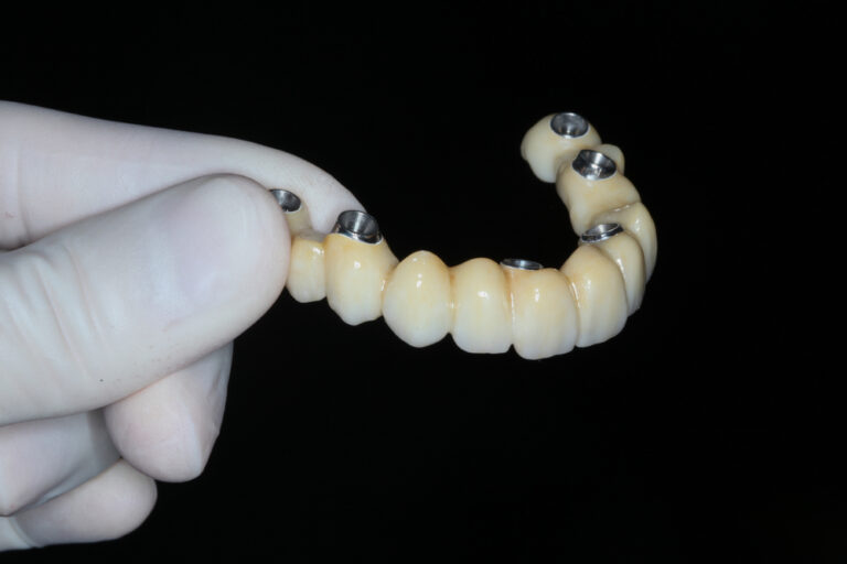 Lucrare dentară fixă pe implanturi pentru o arcadă completă
