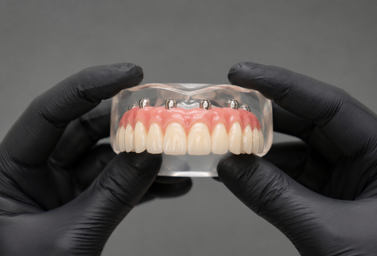 Arcadă dentară superioară cu proteză fixă susținută de 6 implanturi dentare