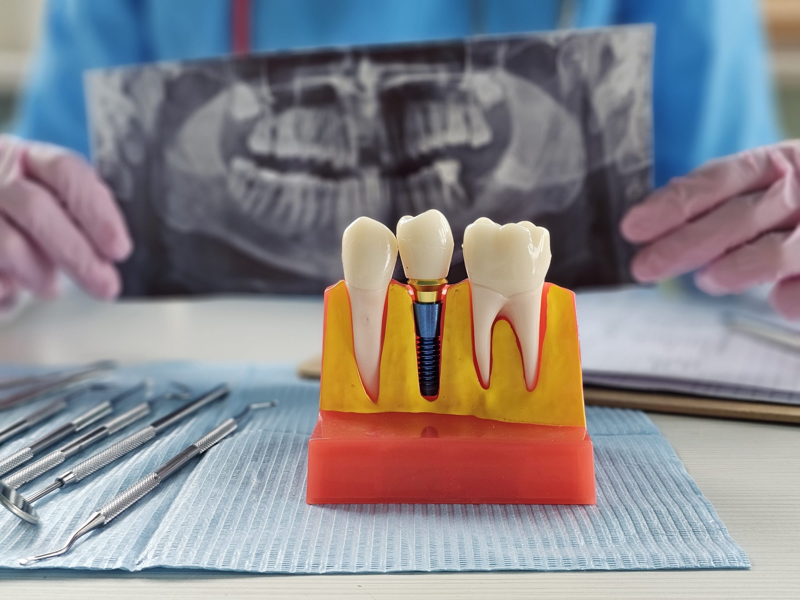 Coroană dentară fixată pe un implant dentar Nobel Biocare cu aspect natural