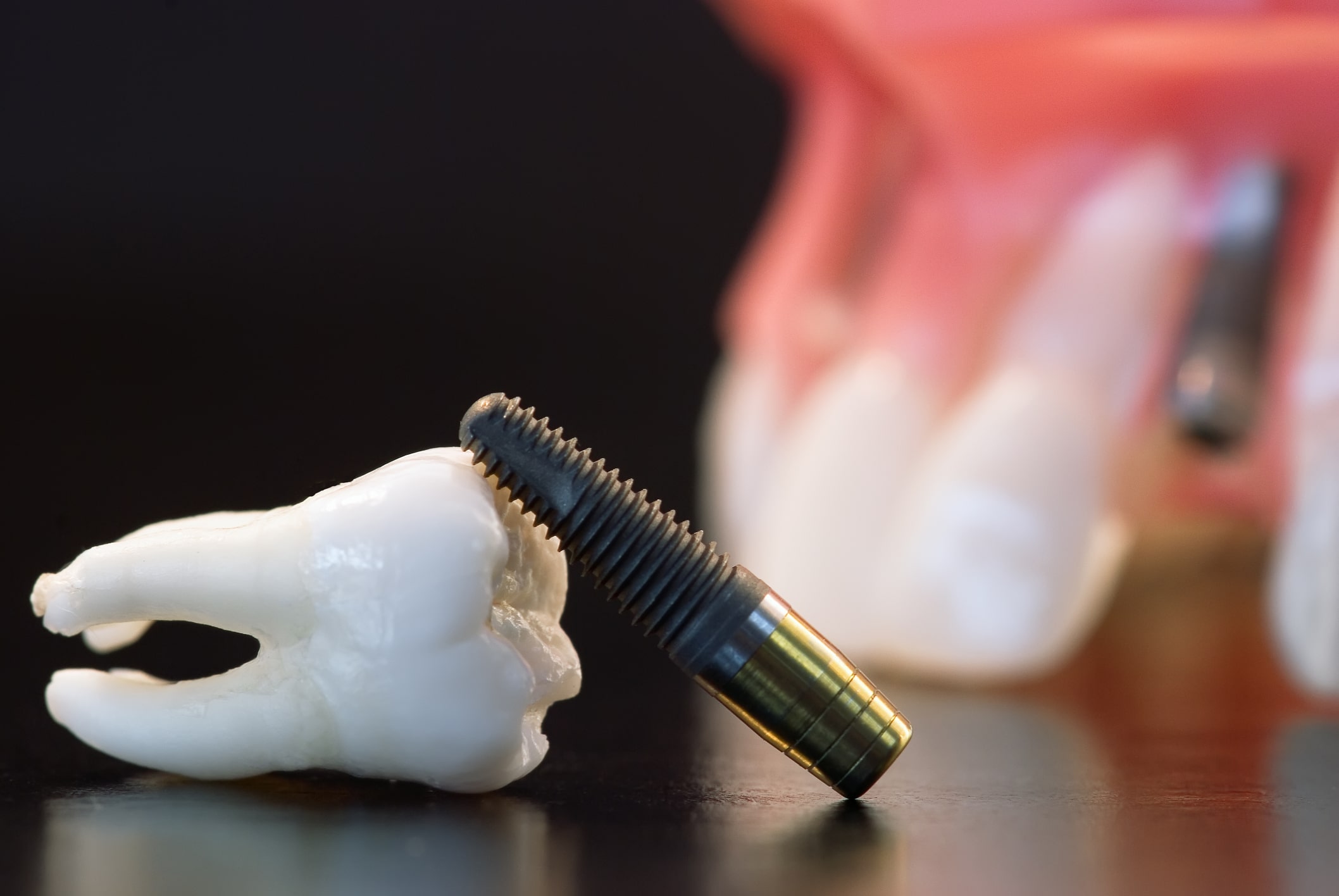 Implant dentar Alpha Bio montat la Clinicile Stomatologice ProDent Dr. Gruia din București și Câmpina