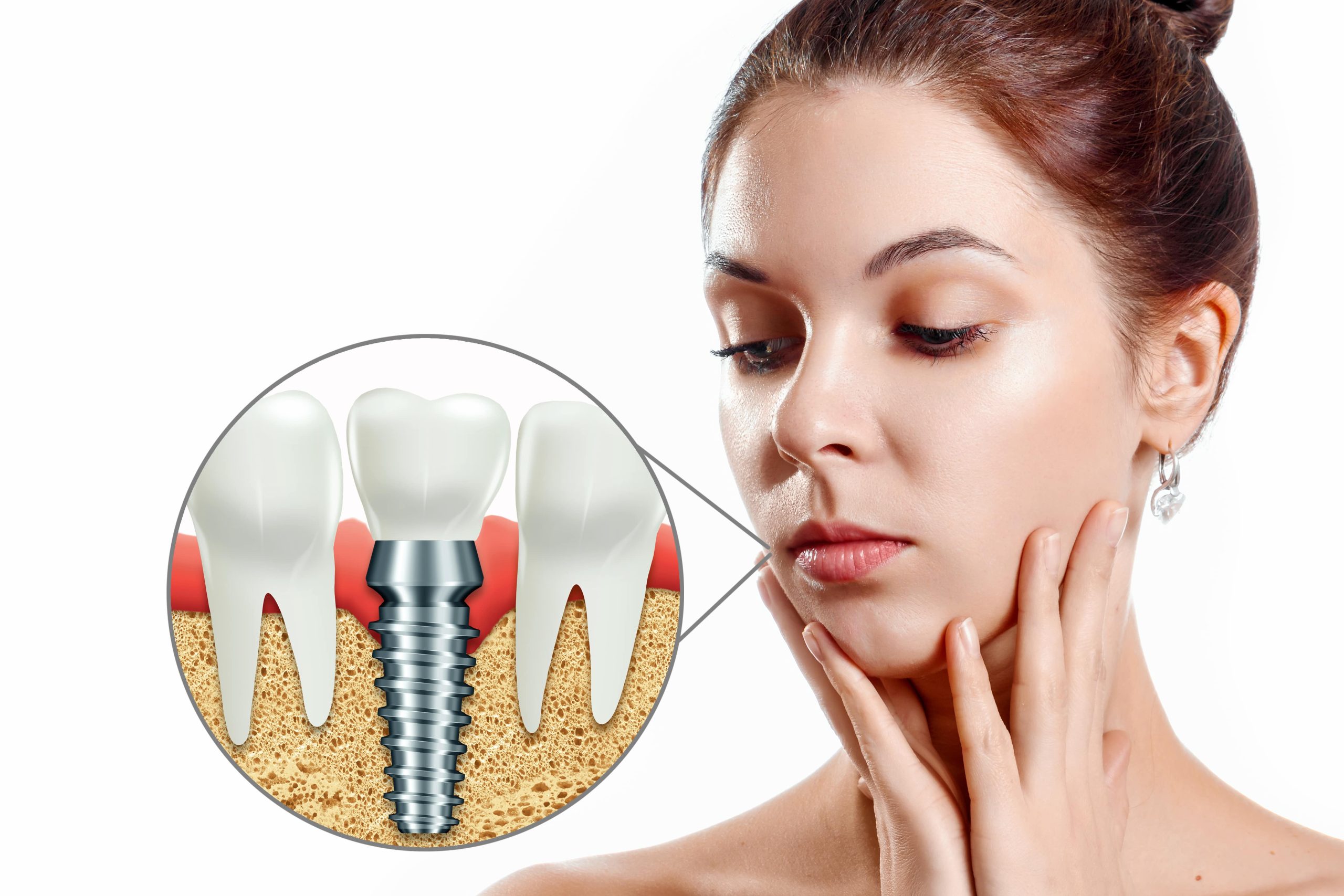 Implant dentar Nobel Biocare utilizat pentru înlocuirea unui dinte lipsă