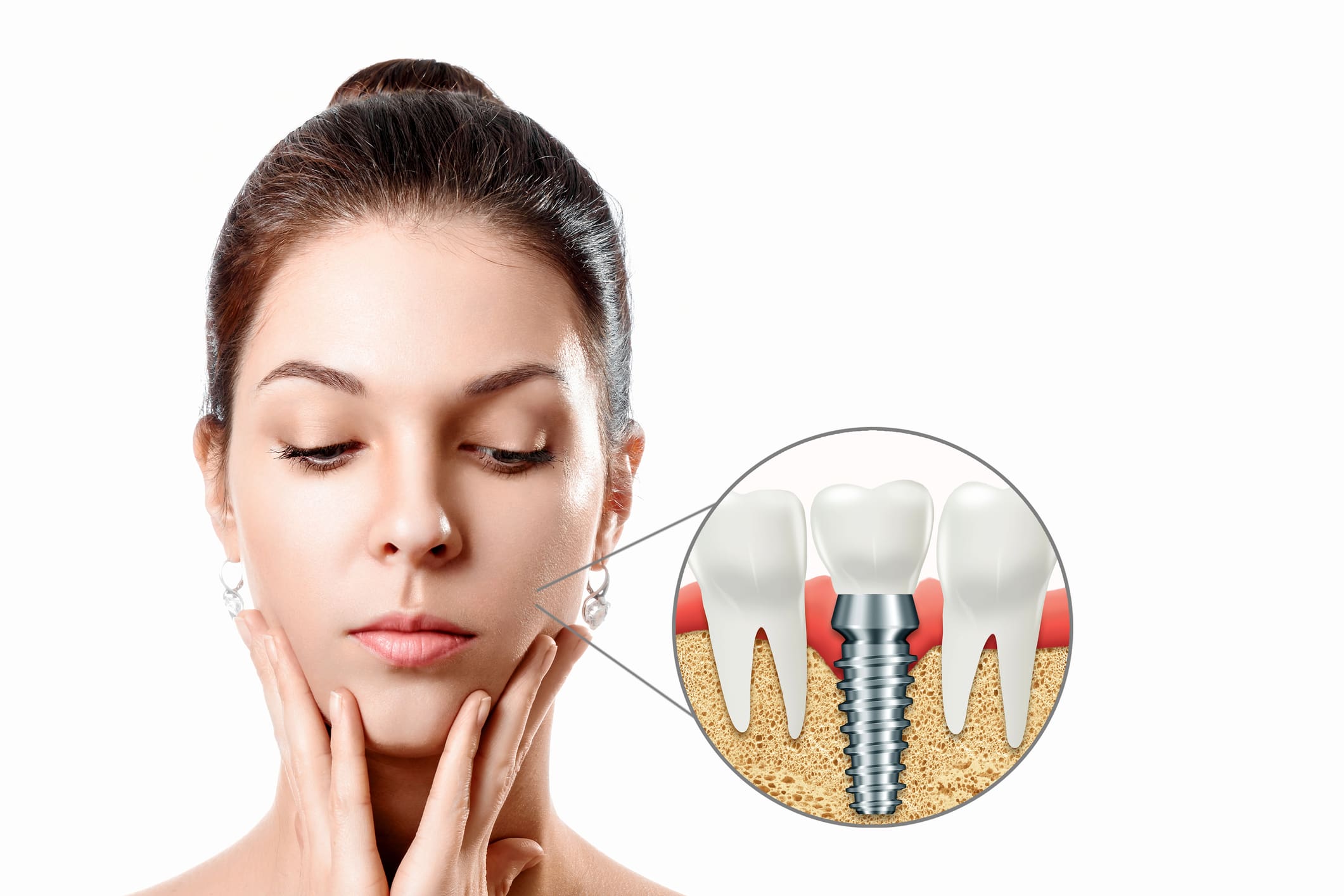 Zâmbet restaurat cu implant dentar Nobel Biocare la ProDent Dr. Gruia